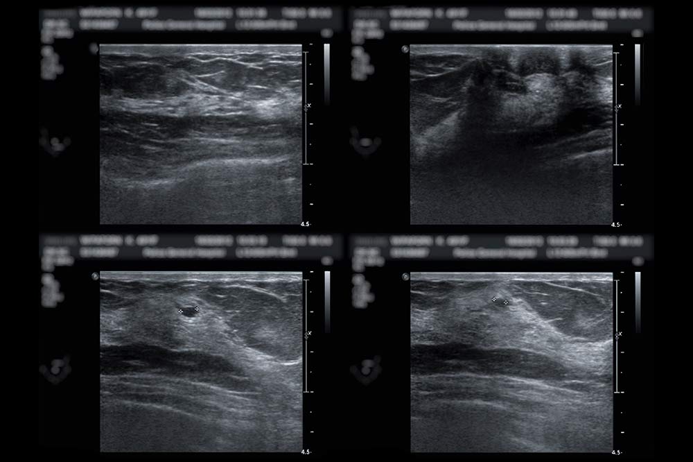 breast ultrasound at florida radiology consultants.jpg