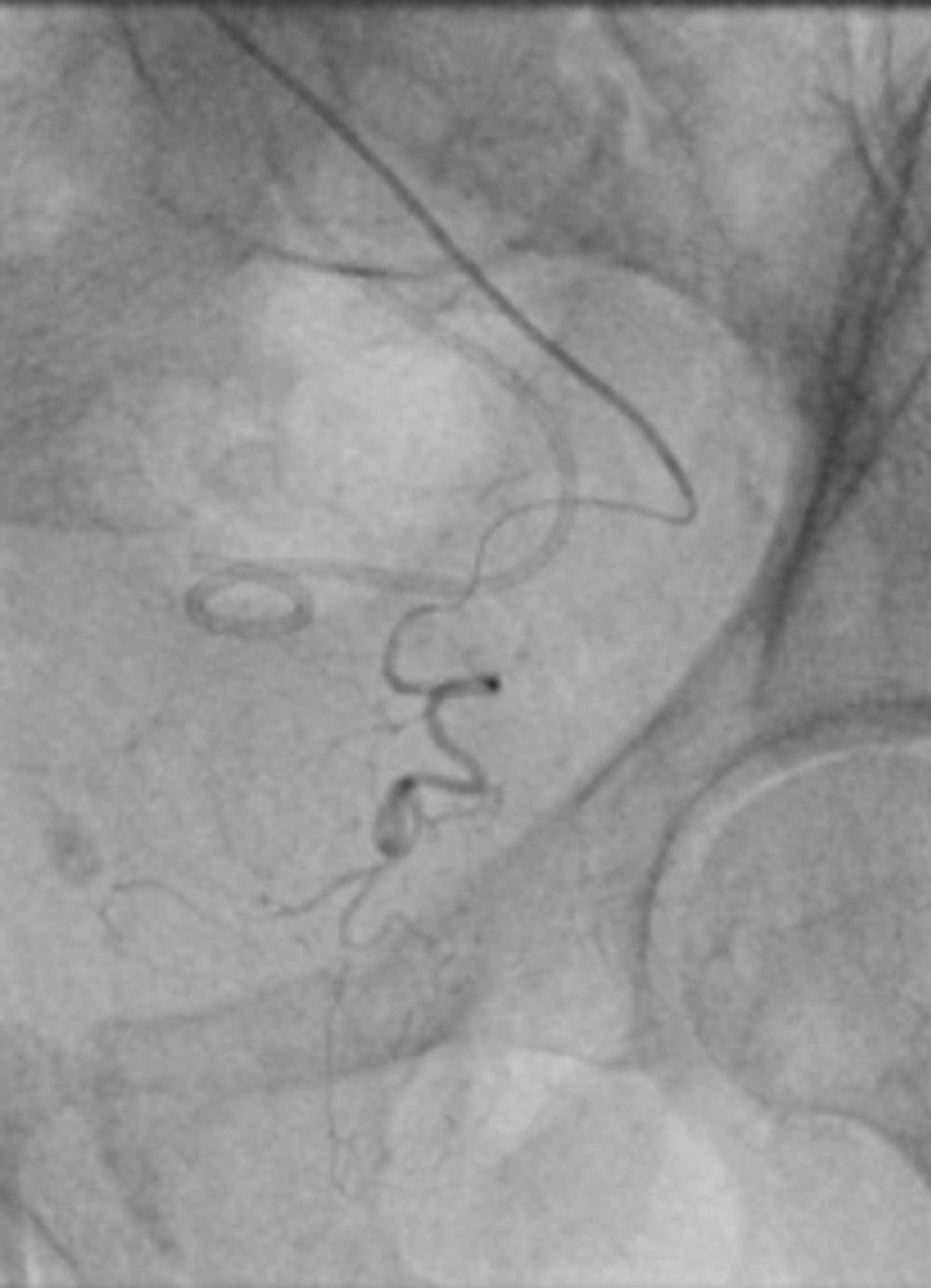 Prostate Artery Embolization