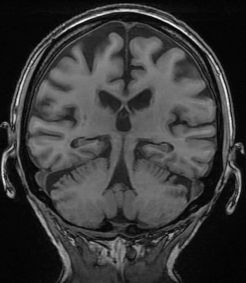 MRI imaging for Alzheimers/memory loss