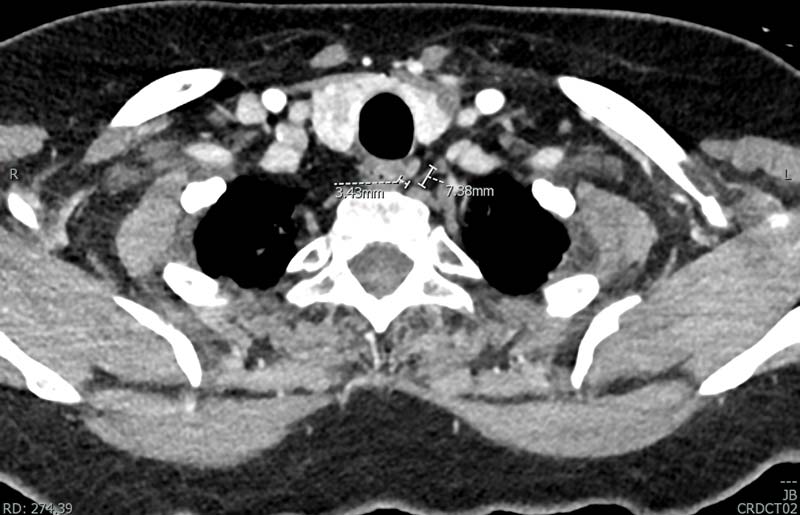 CT parathyroid