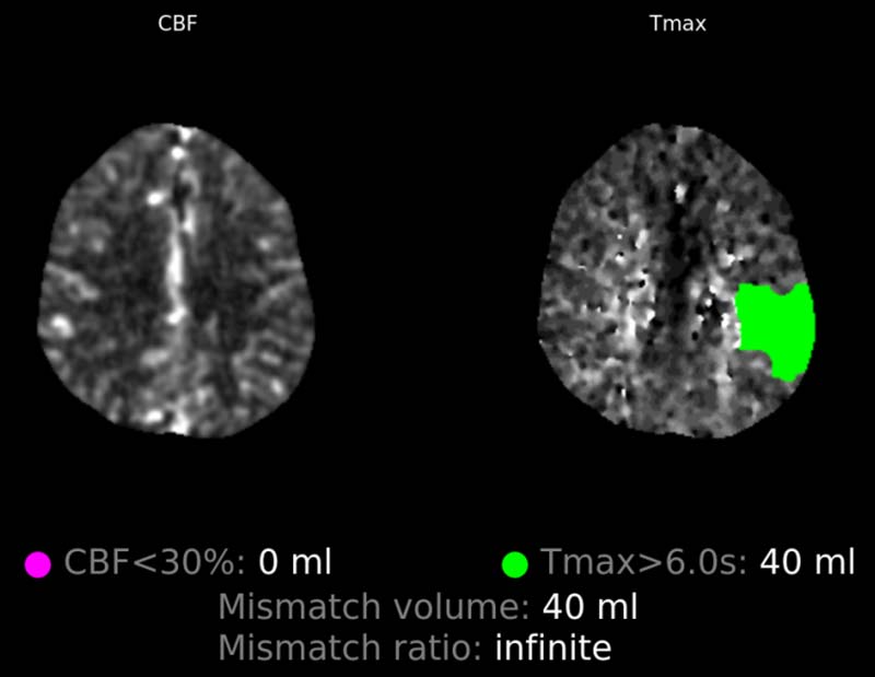 CT Perfusion Study