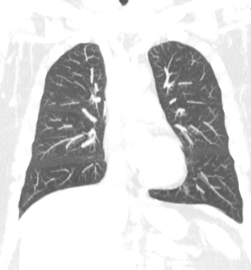 Low dose CT chest