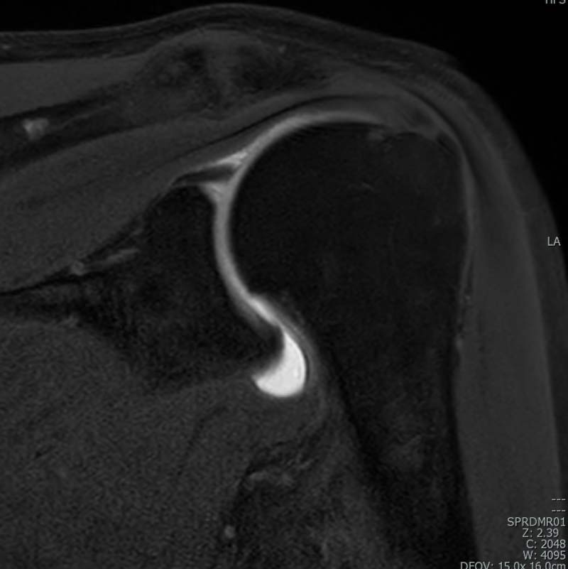 MRI Anthrography Shoulder - Interventional Radiology Image