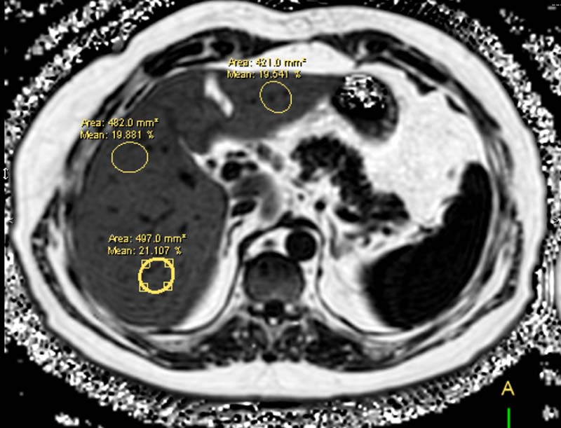 MRI Elastography