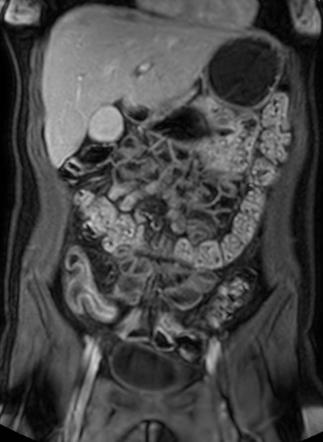 MRI enterography