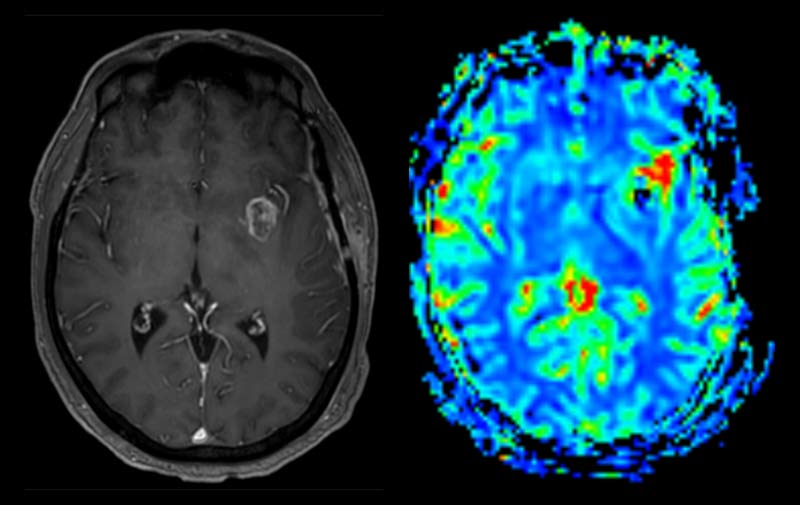 MRI head perfusion study