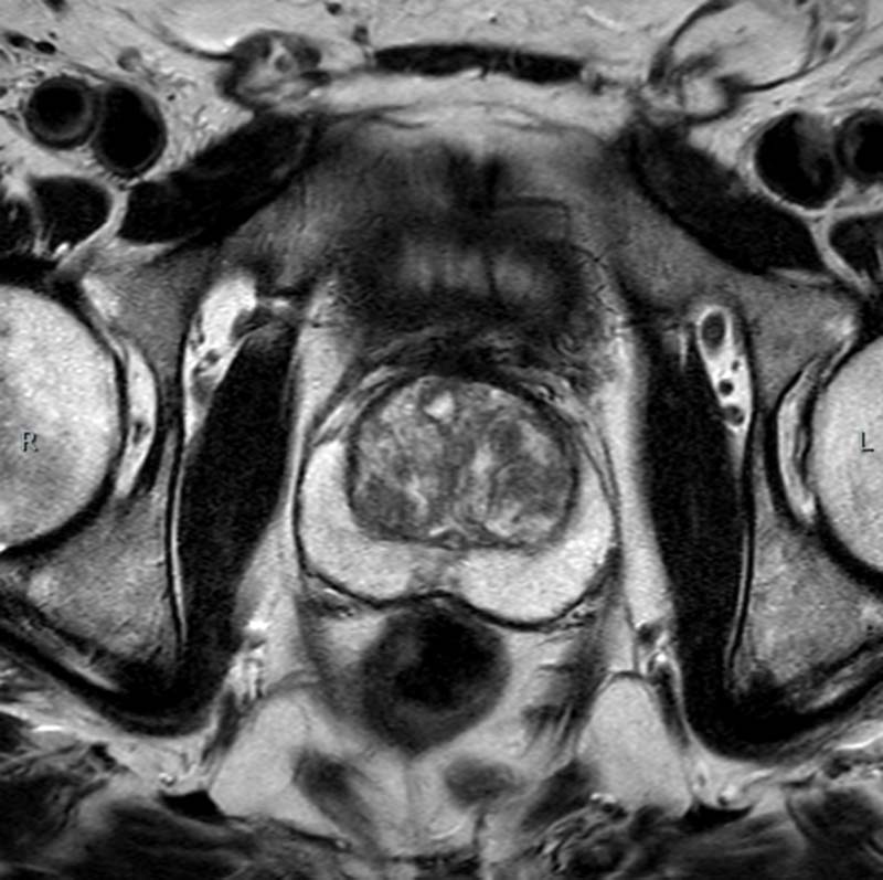 Prostate MRI